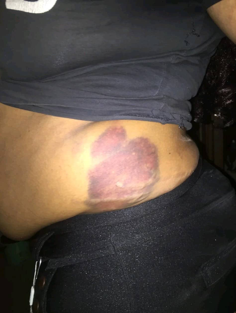 Lady shares photos of injuries she sustained after being assaulted by drunk 'baby daddy'