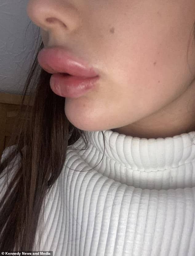 Lady Claims That A £100 Filler Treatment Left Her Lips So Swollen