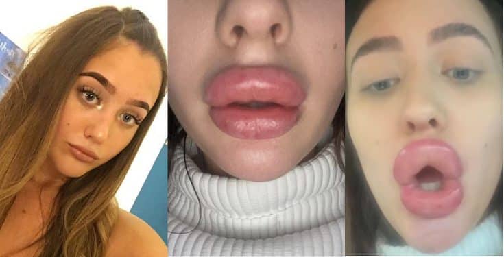 Lady Claims That A £100 Filler Treatment Left Her Lips So Swollen 