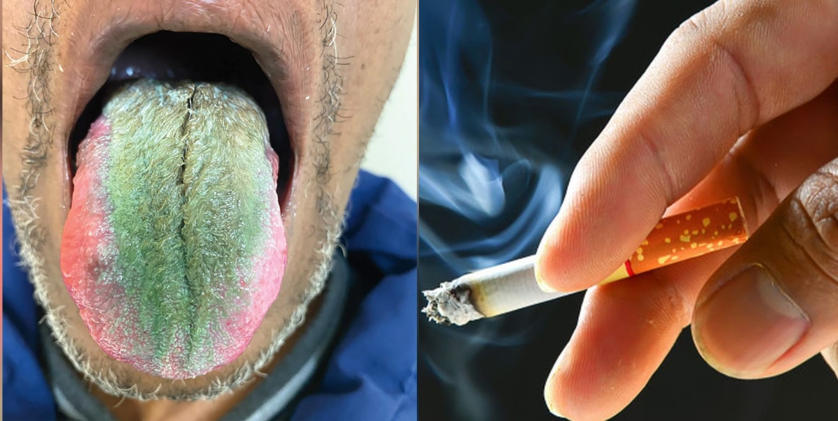 Man grows green hairs on his tongue following alleged reaction to ...