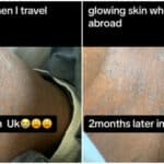 Lady heartbroken as she still battles with skin issue 2 months after arriving in the UK, expects flawless skin (Video)