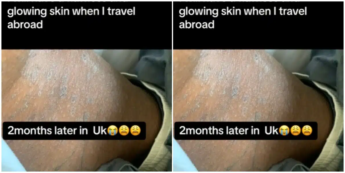 Lady heartbroken as she still battles with skin issue 2 months after arriving in the UK, expects flawless skin (Video)