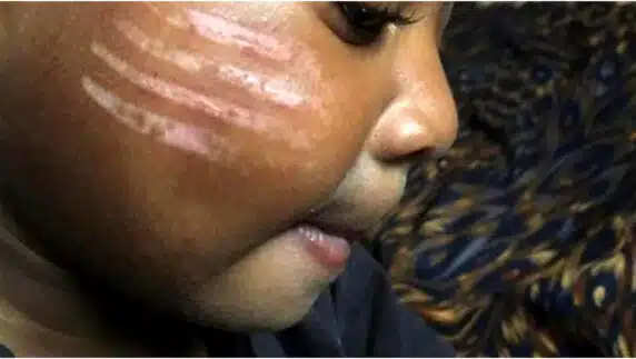 Mother angry as daycare teacher gives child four long tribal marks on cheeks