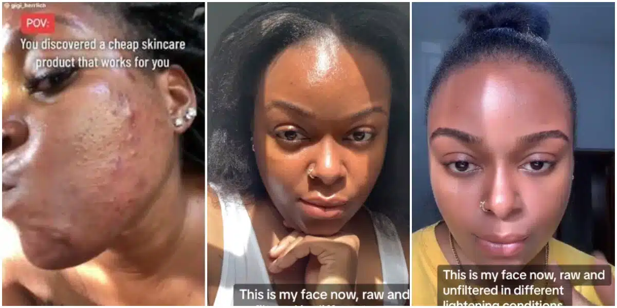 "It cost less than N1k" - Lady who battled severe acne shares skin routine that gave her incredible facial transformation