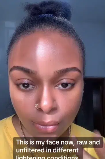 "It cost less than N1k" - Lady who battled severe acne shares skin routine that gave her incredible facial transformation