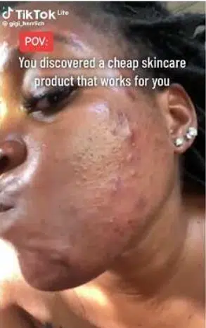 "It cost less than N1k" - Lady who battled severe acne shares skin routine that gave her incredible facial transformation