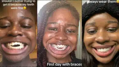 Lady shares beautiful result after wearing braces for five years