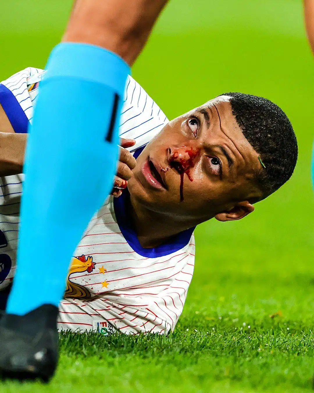 France coach Deschamps reveals Mbappe will need to undergo surgery for broken nose