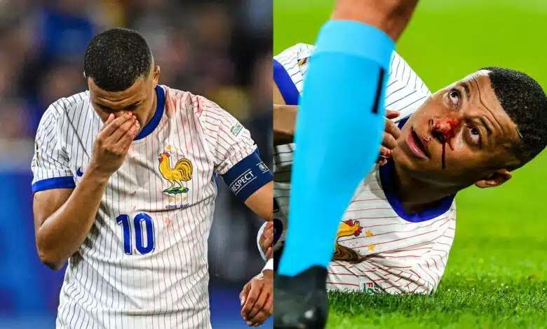 Euro 2024: Mbappe to wear mask after nose fracture, confirms French FA