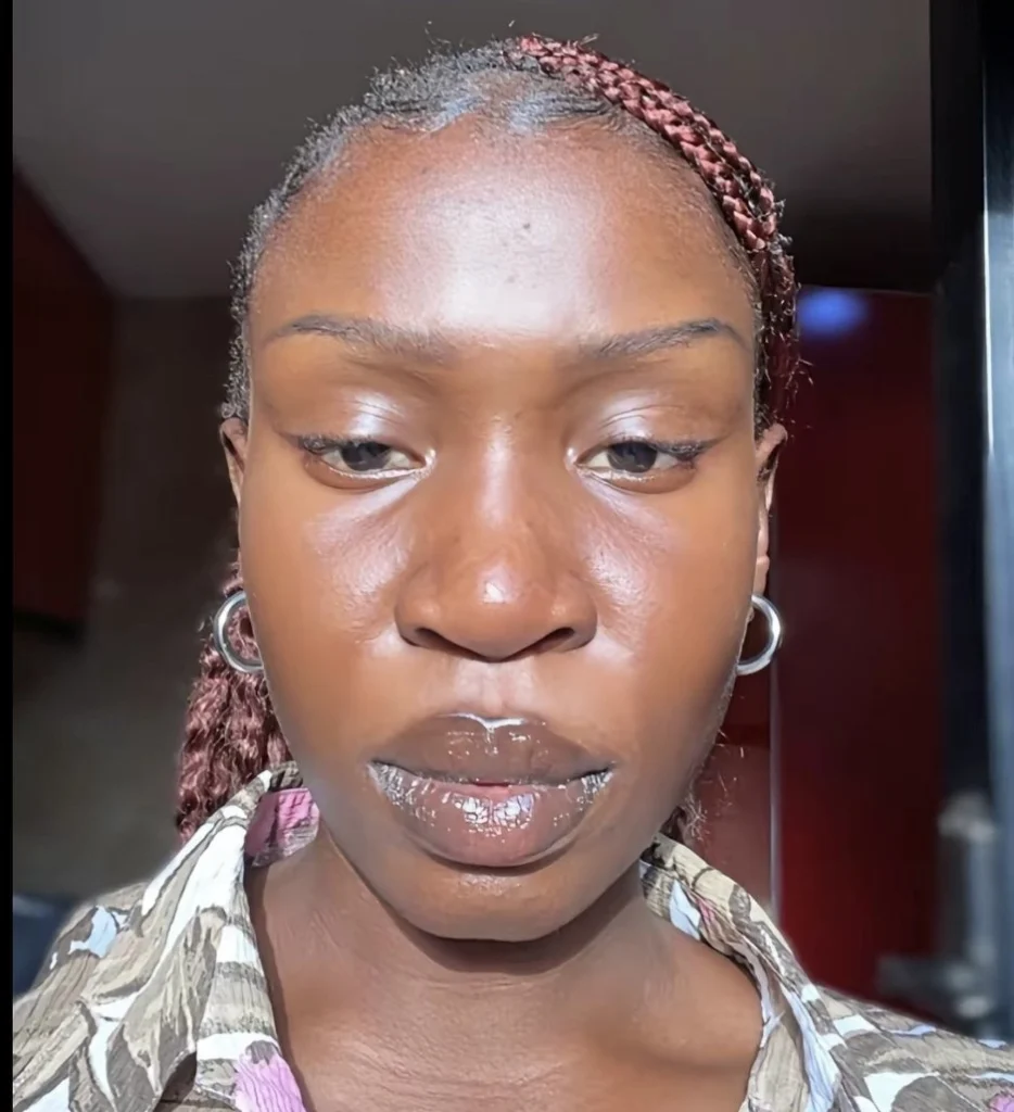 Lady shares the after effect of her allergic reaction to catfish