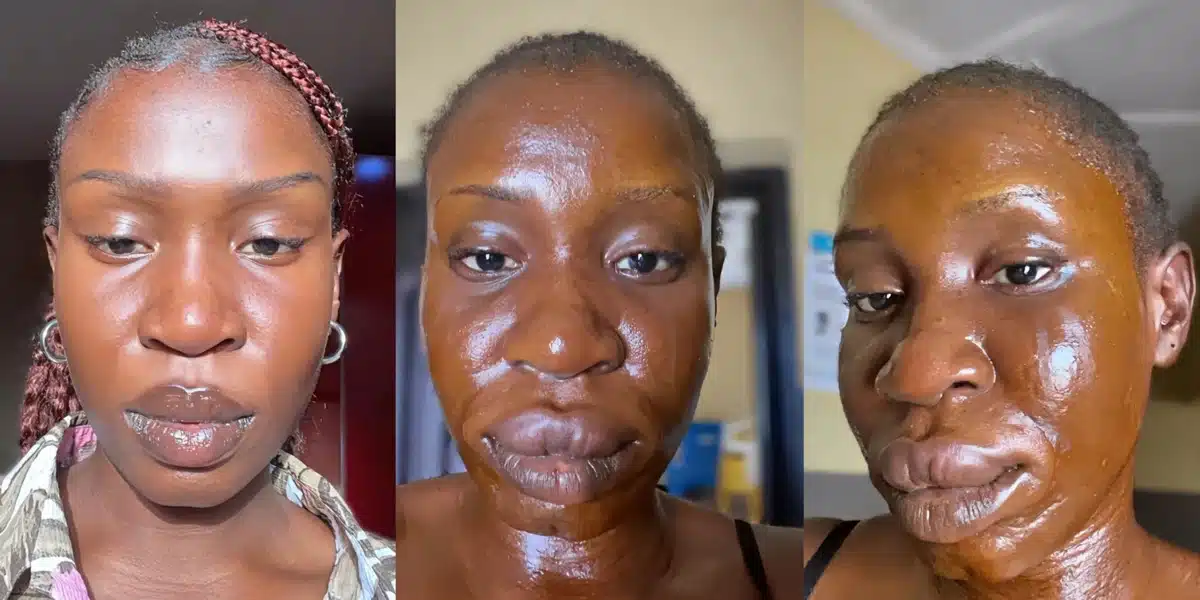 Lady shares the after effect of her allergic reaction to catfish