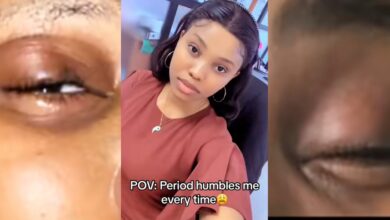 Nigerian lady reveals unusual allergy to menstrual period, shows swollen face