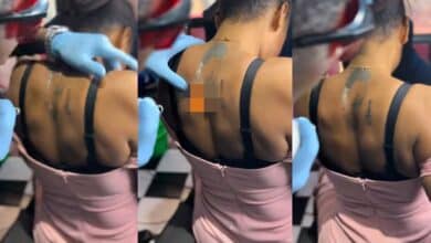 Love turns sour as a lady removes a tattoo of her boyfriend's face from her body, after going through a breakup.