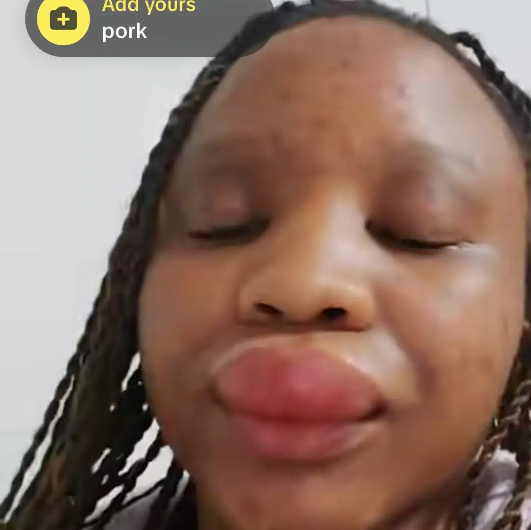 Nigerian woman develops allergy after eating pork, shares shocking video on social media