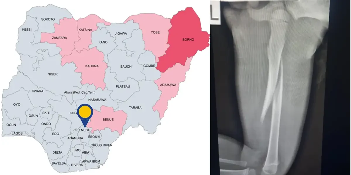 Woman breaks 3-year-old stepson's thigh bone with pestle in Enugu