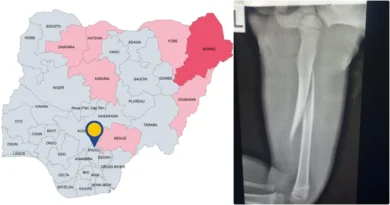 Woman breaks 3-year-old stepson's thigh bone with pestle in Enugu