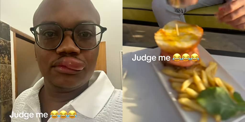 Man shocks the internet by developing allergy to potatoes, causes swollen lip after eating them