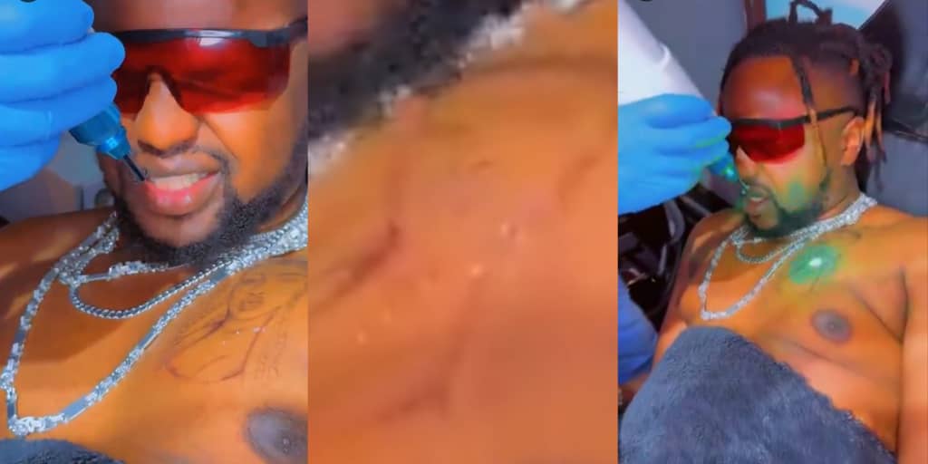 Man painfully erases tattoo of ex-girlfriend’s face after breakup