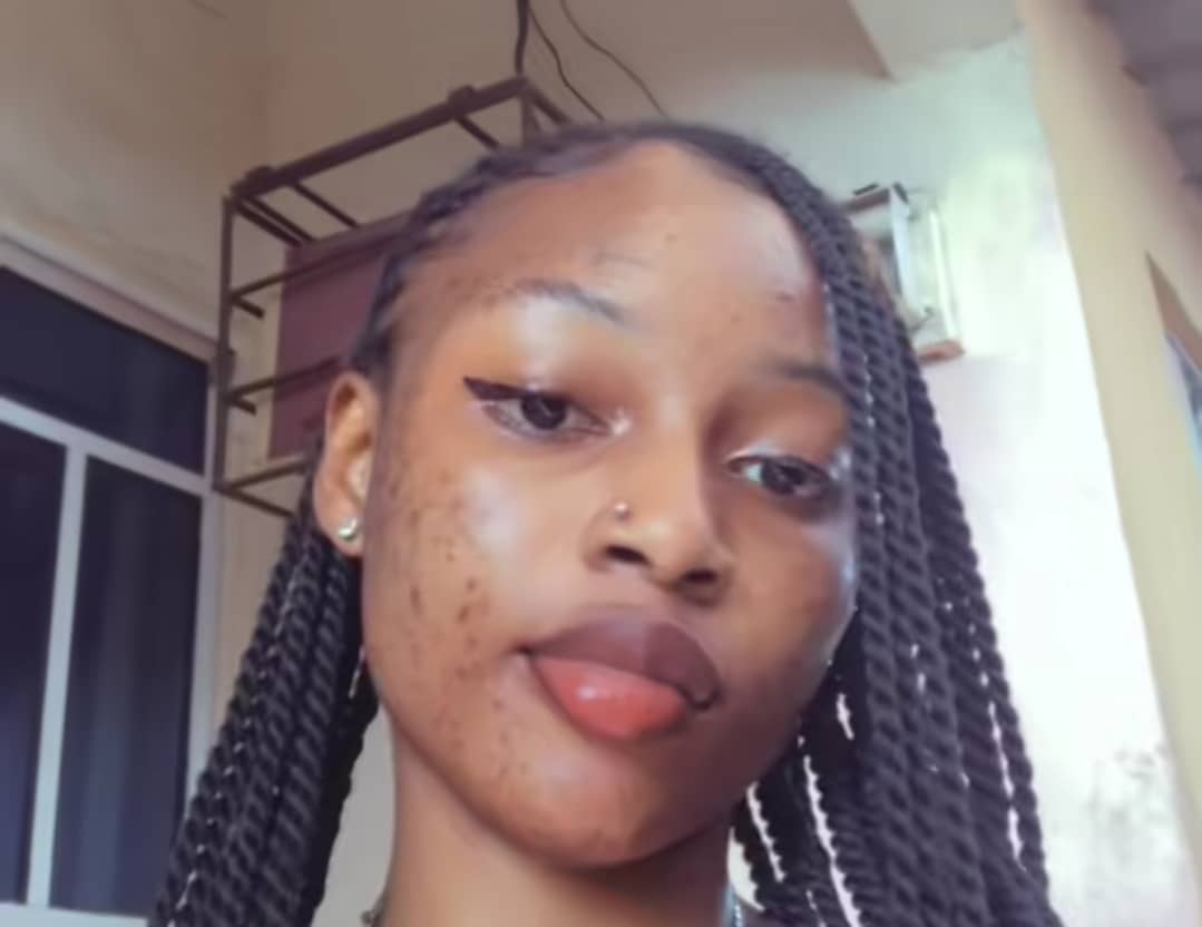 Lady shares shocking skin reaction after using hyped TikTok skincare product