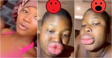 Lady cries out over sudden lips transformation after a fun day