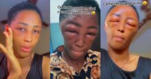 Lady suffers allergic reaction after applying dye on hair