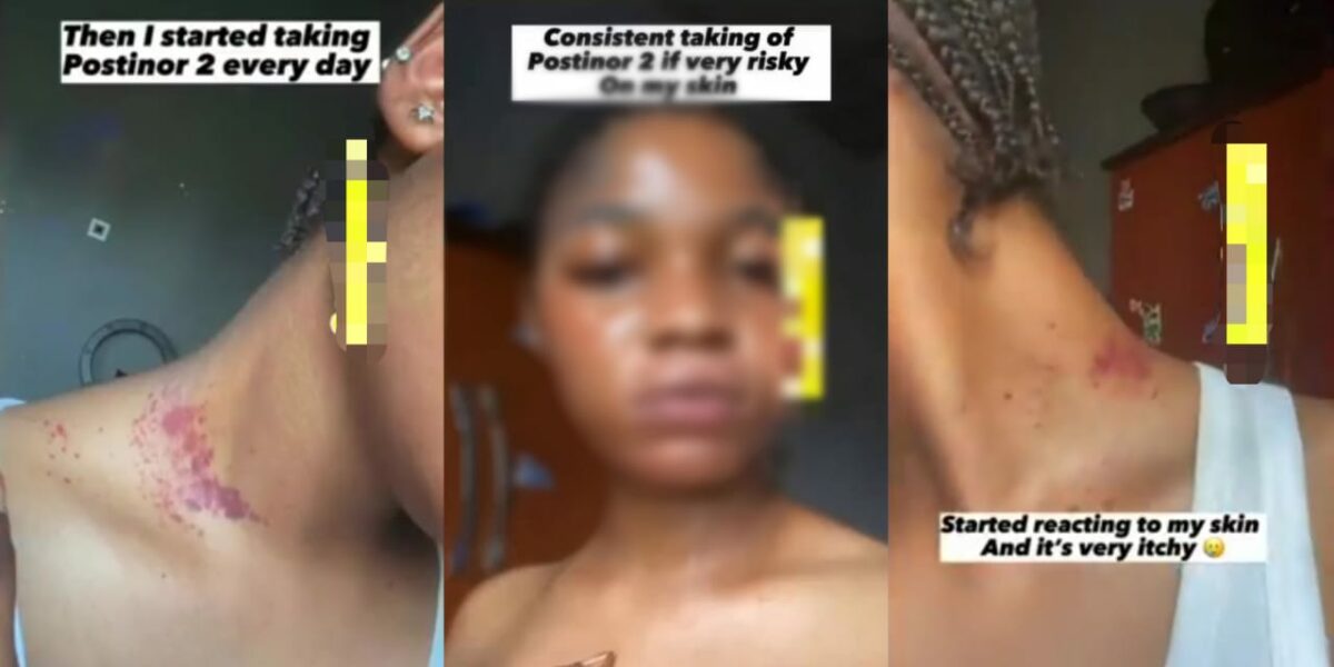 Lady shares shocking skin effects after taking Postinor-2 daily