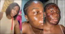 Lady cries out after severe burn from vendor's 'free' acne procedure