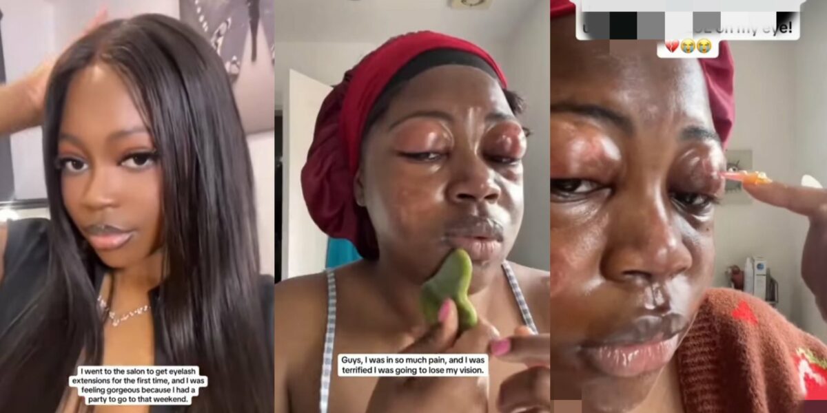 Lady shares how eyelids began to swell after using eyelash extensions