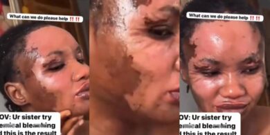 Lady uses special chemical to bleach her skin, flaunts results